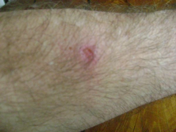 Bite chagas arm infected healing001
